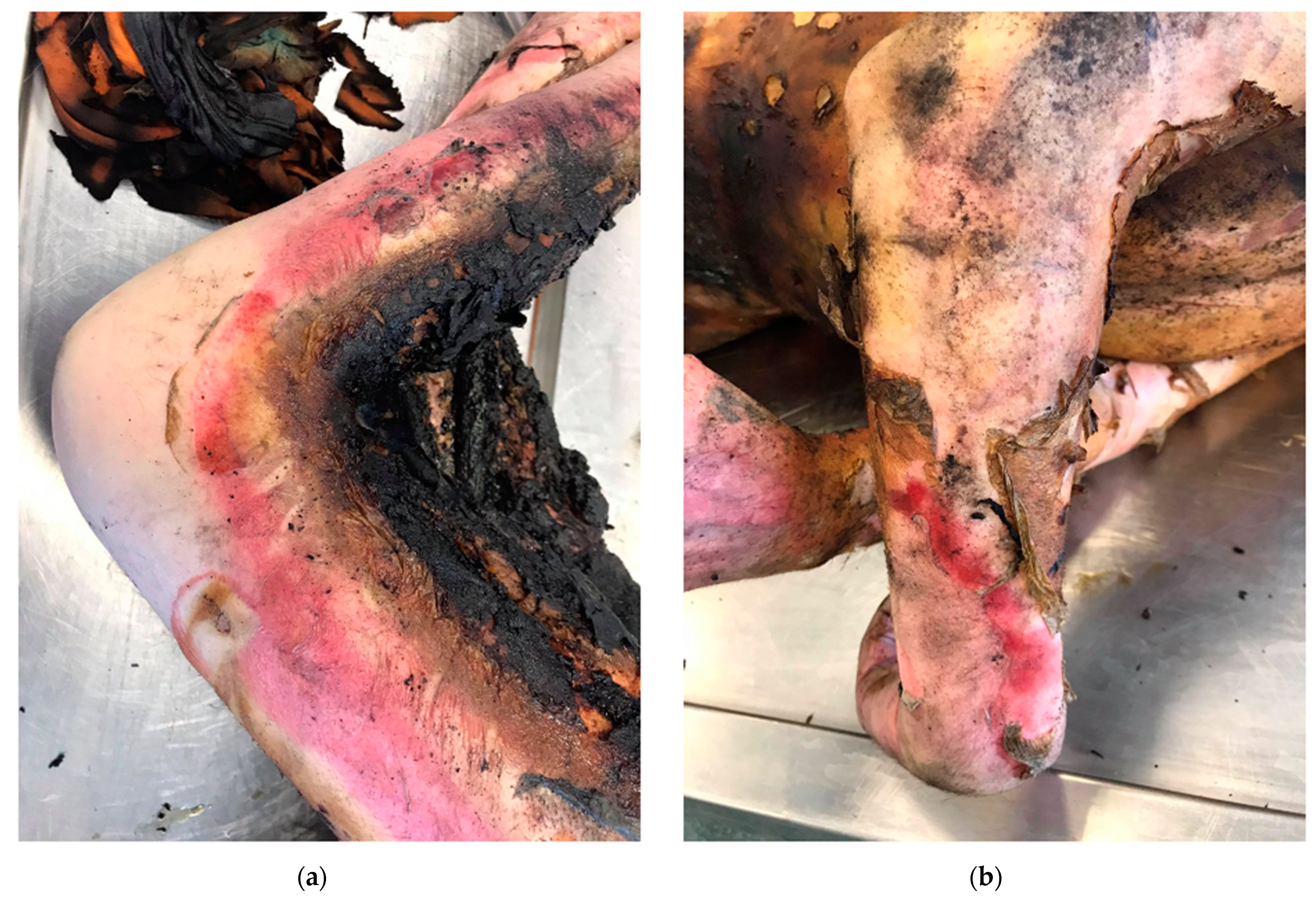IJERPH | Free Full-Text | Burn Wound Healing: Clinical Complications,  Medical Care, Treatment, and Dressing Types: The Current State of Knowledge  for Clinical Practice