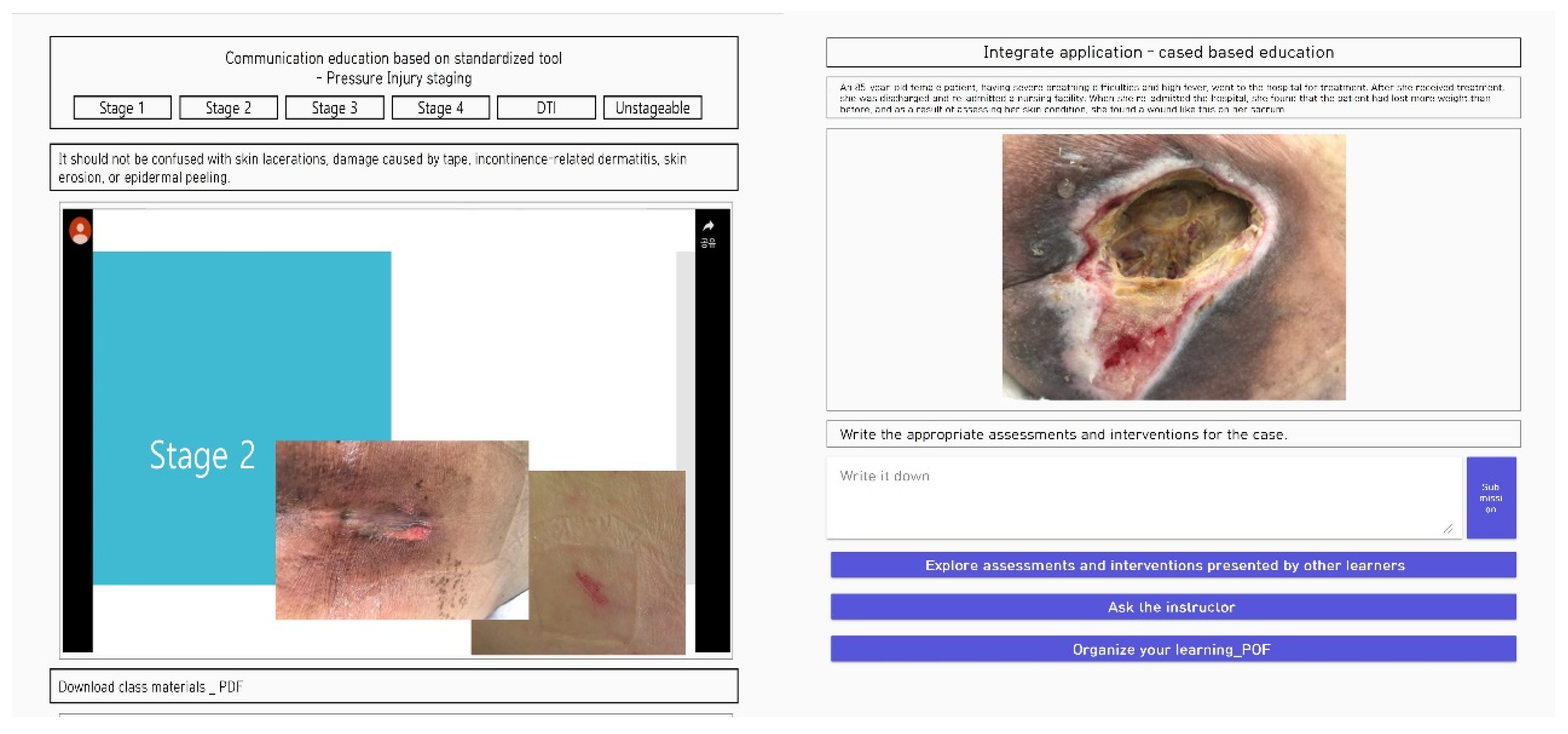 How to Determine if a Resident is at a High Risk of Pressure Ulcers