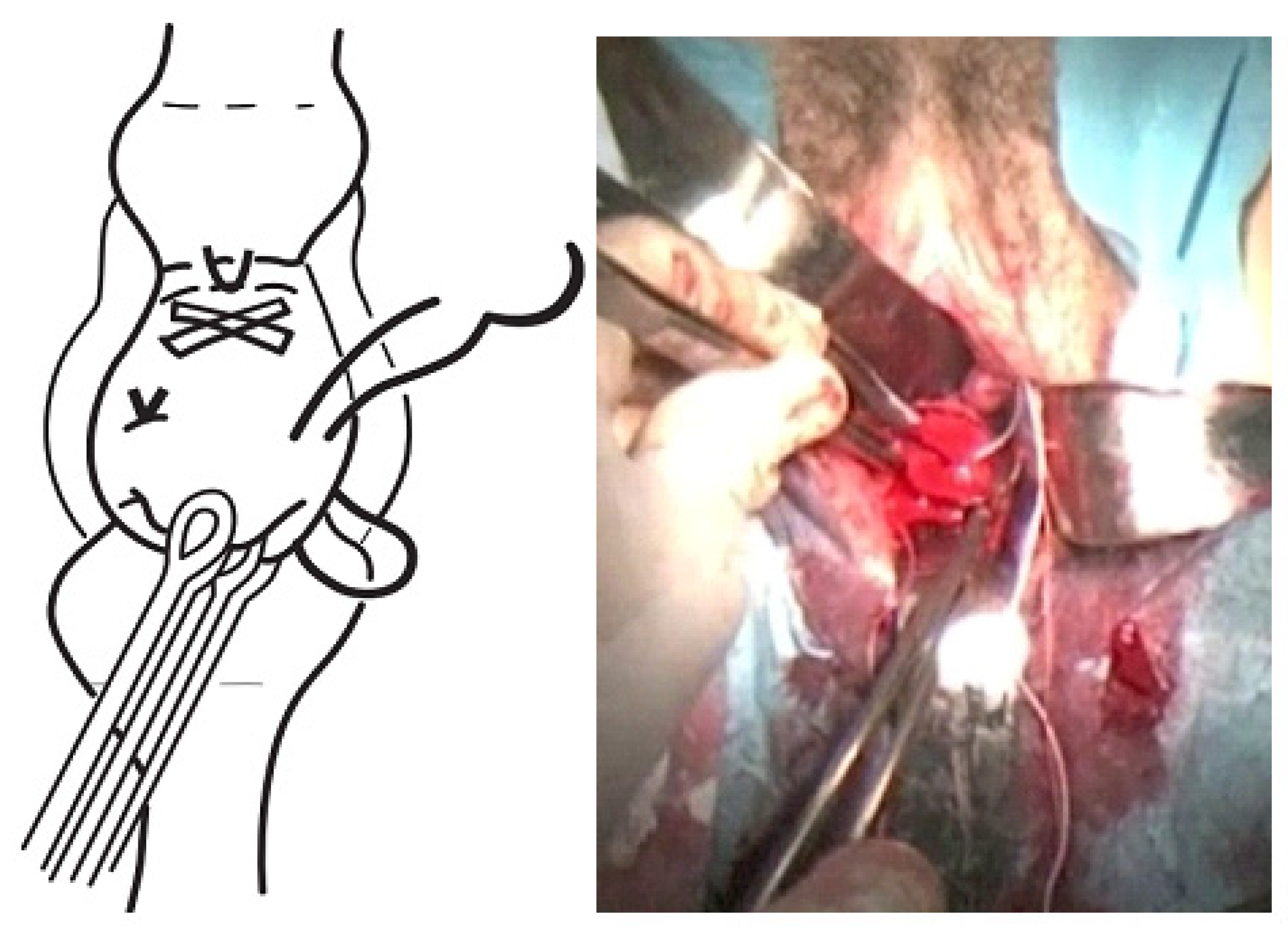 Monofilament suture versus braided suture thread to improve pregnancy  outcomes after vaginal cervical cerclage (C-STICH): a pragmatic randomised,  controlled, phase 3, superiority trial - The Lancet