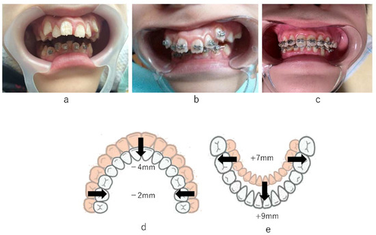 Visually almost symmetrical braces mainly correcting via trunk