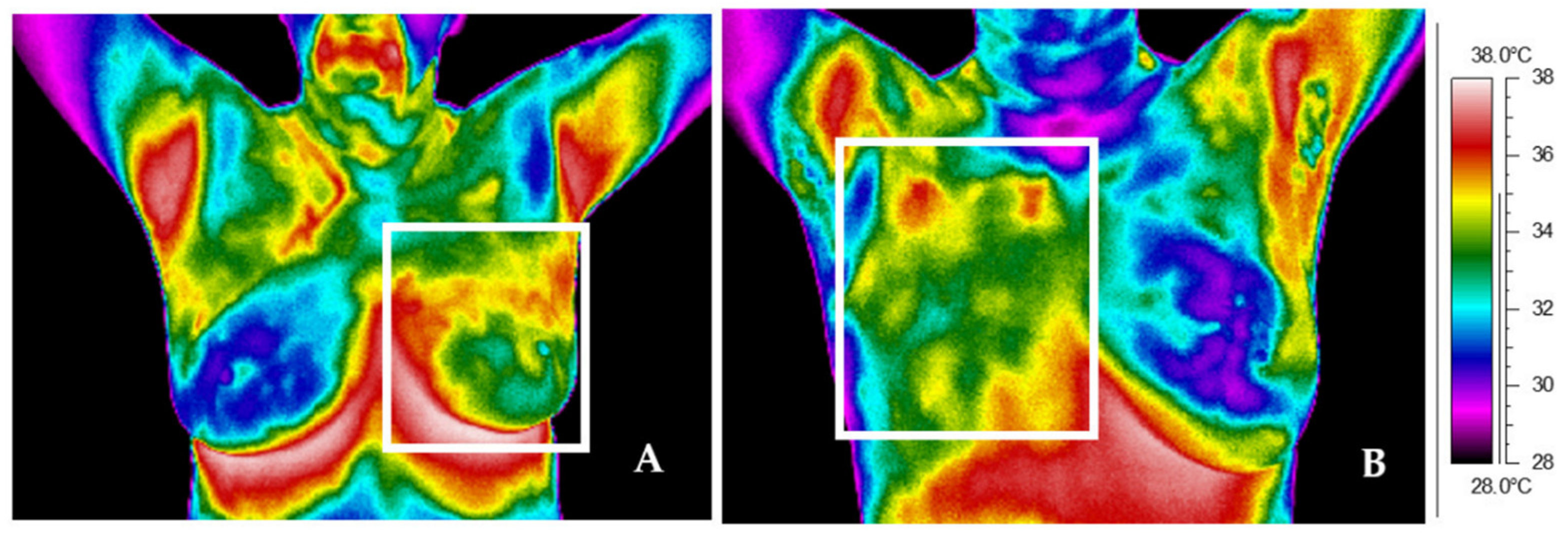 Two Ways Bras Affect Our Breast Health - The Thermogram Center