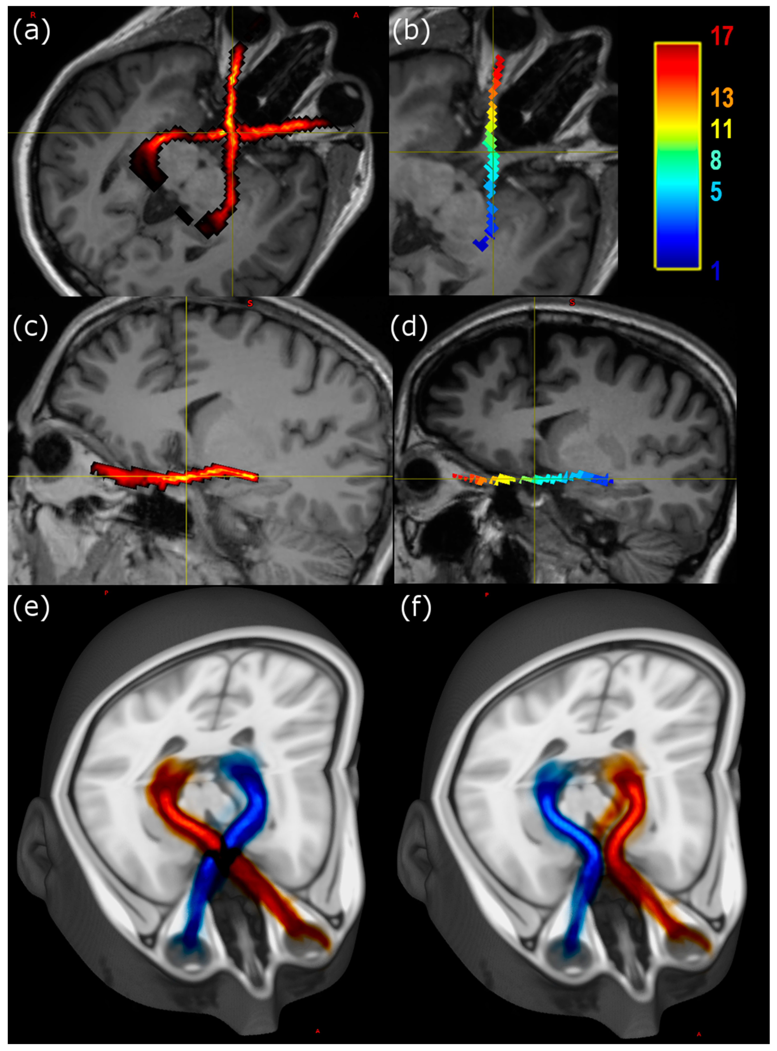 IJERPH | Free Full-Text | Multishell Diffusion MR Tractography 