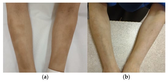 The Scope Blog - Medical Treatment for Varicose Veins - Tanner