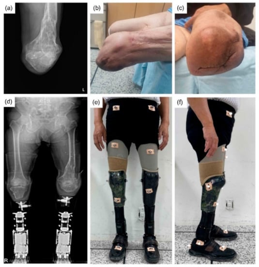 Osseointegration Limb Replacement: More Control for Amputees