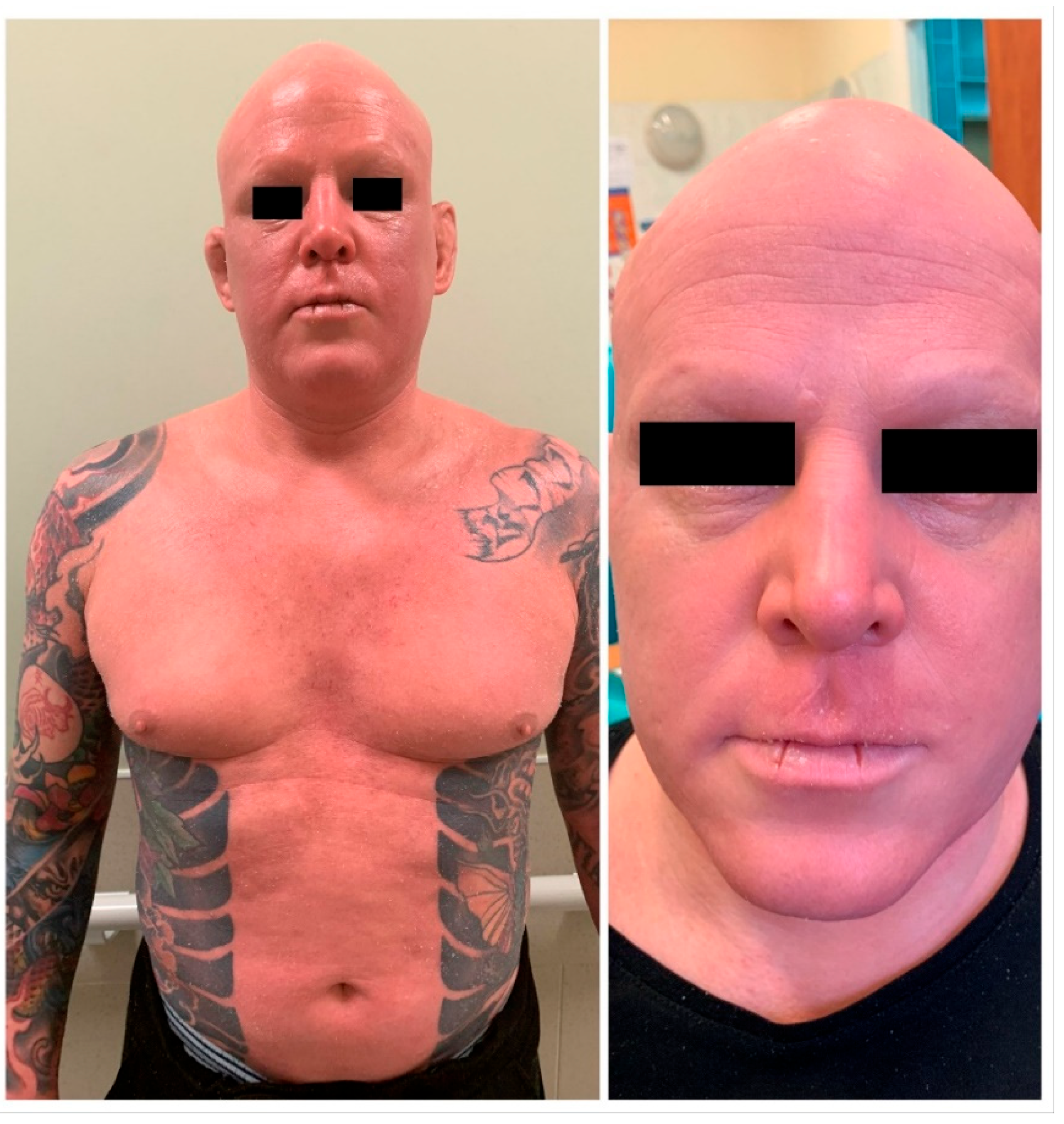 Healing experience with my allergic reaction to tattoo ink. (Black ink  allergy) : r/tattooadvice