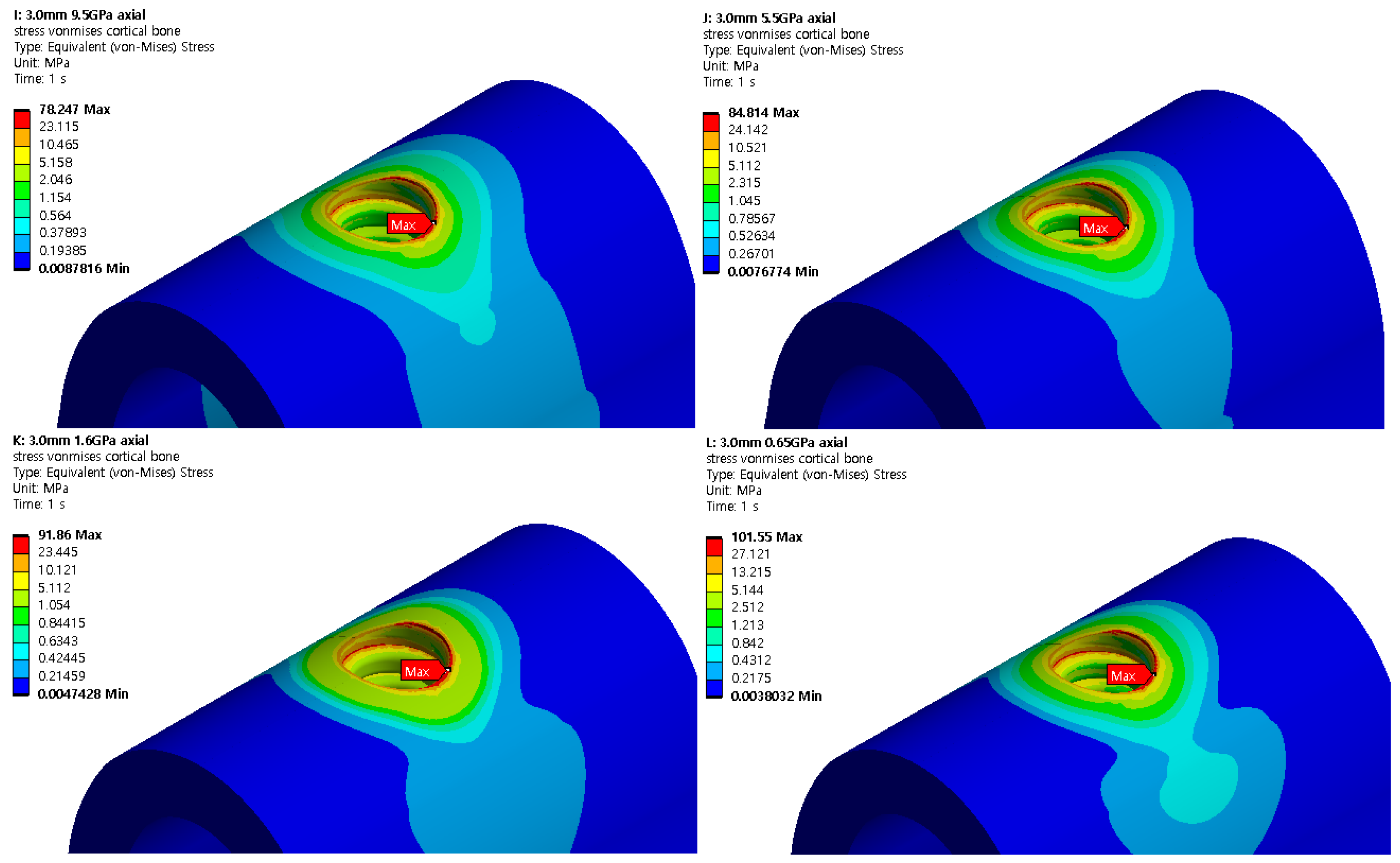 IJERPH | Free Full-Text | Stress Distribution Analysis of Threaded ...