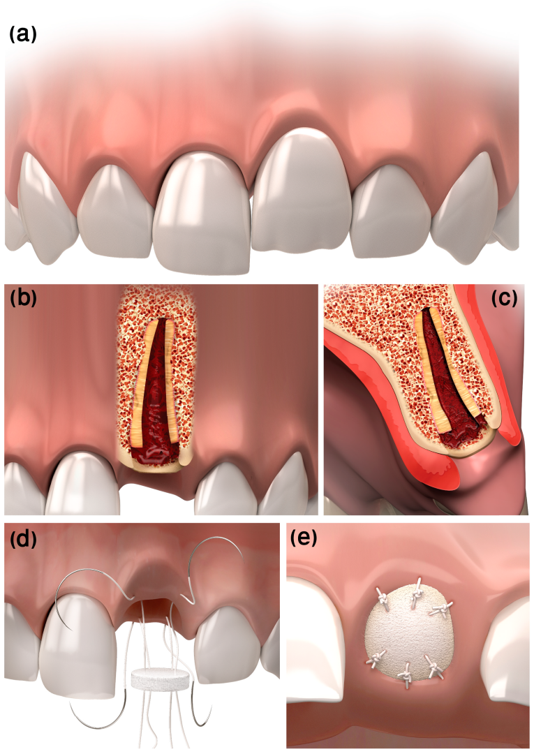 IJERPH | Free Full-Text | Flapless Decoronation: A Minimally Invasive ...