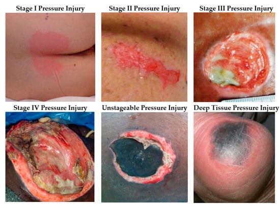 WHEELCHAIR CUSHIONS: Healing Pressure Ulcers by Addressing SHEAR