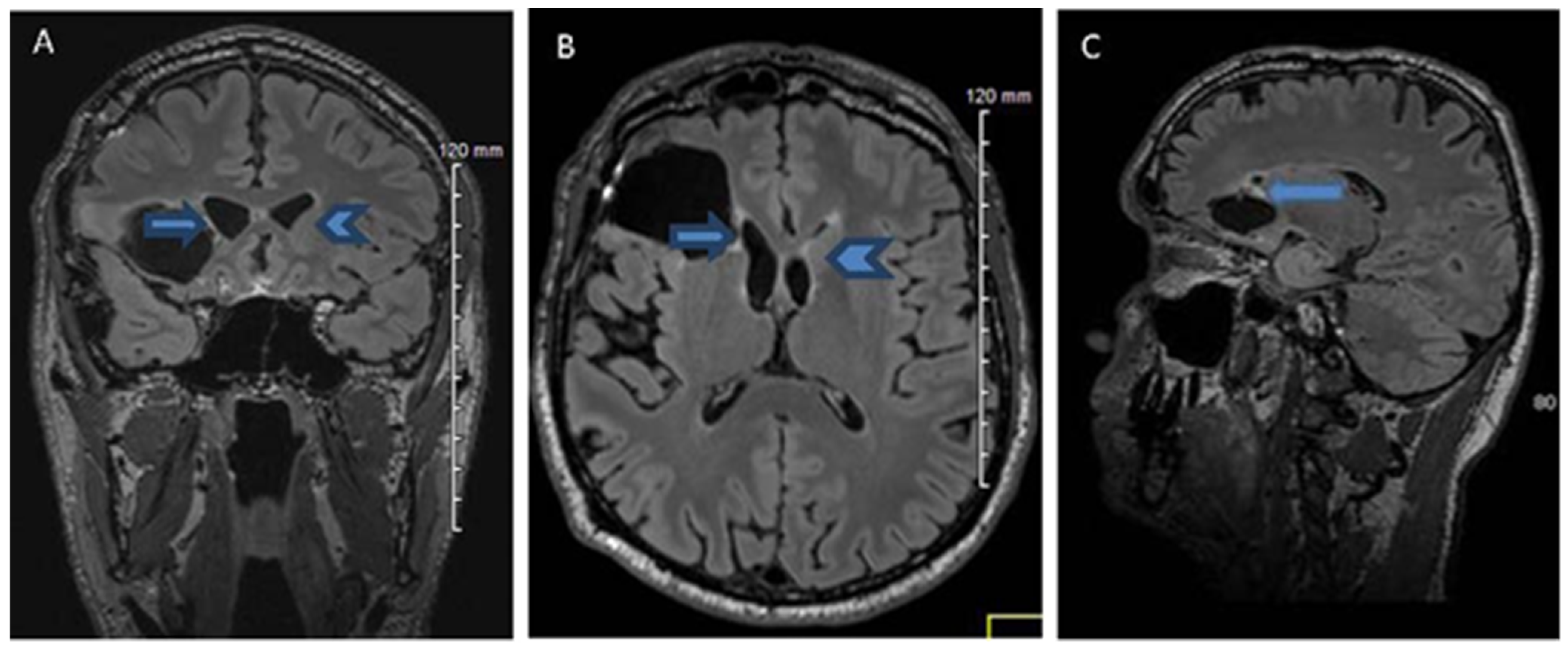 IJERPH | Free Full-Text | A Crossed Pure Agraphia by Graphemic Buffer  Impairment following Right Orbito-Frontal Glioma Resection