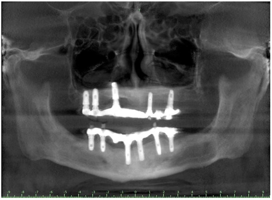 IJERPH | Free Full-Text | Implant Survival in Patients with Chronic ...