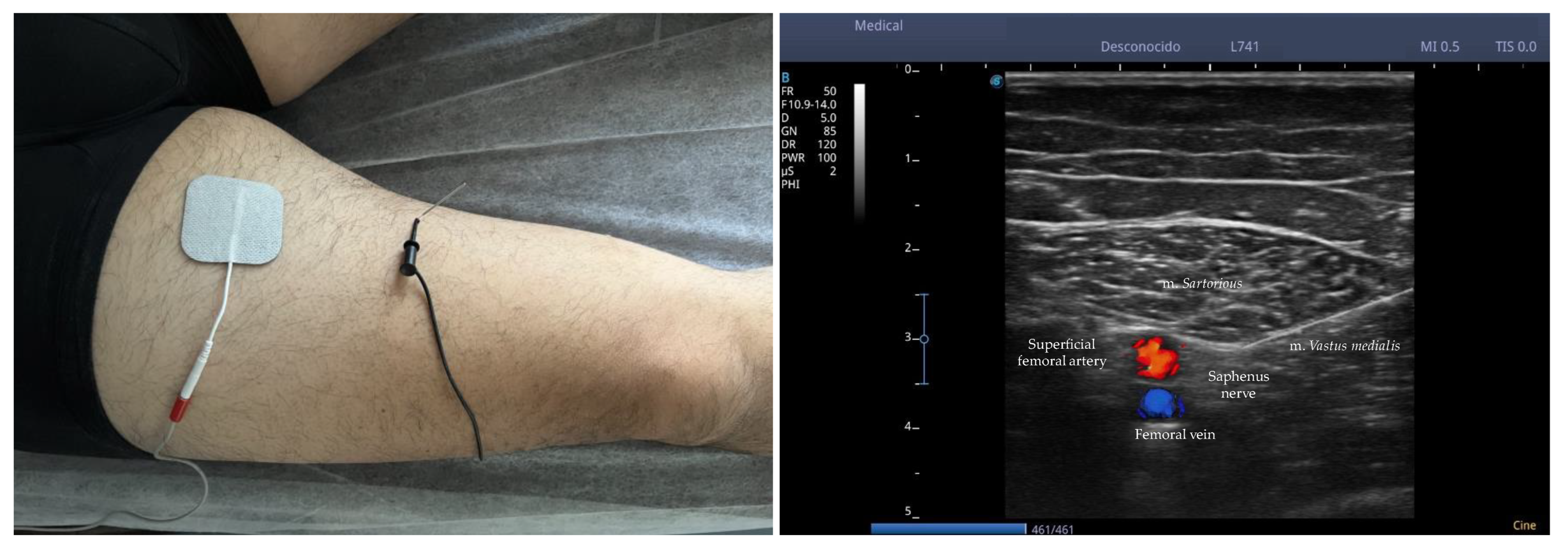 Percutaneous Electrical Nerve Stimulation and Electrical Muscle