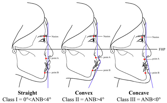 IJERPH | Free Full-Text | Facial Soft Tissue Thickness Differences among  Three Skeletal Classes in Korean Population Using CBCT