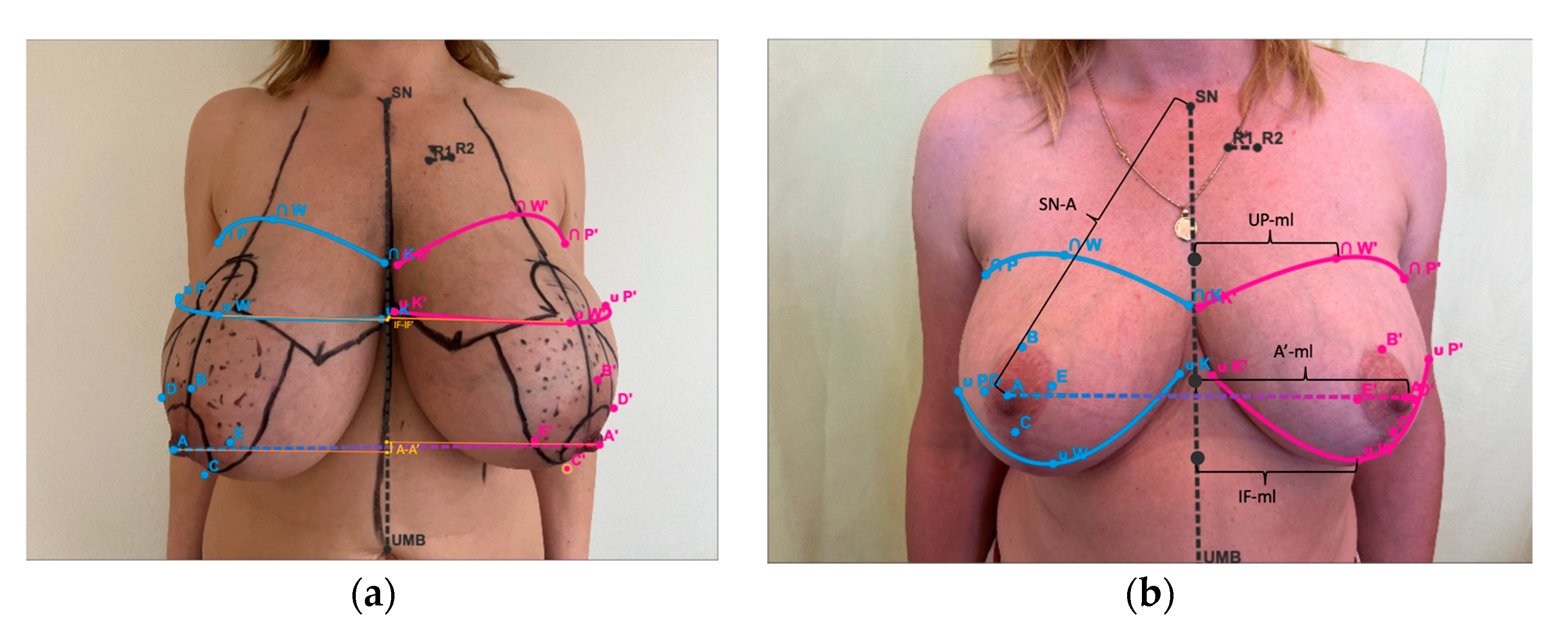 When to Consider a Breast Lift From a Plastic Surgeon - Paul C