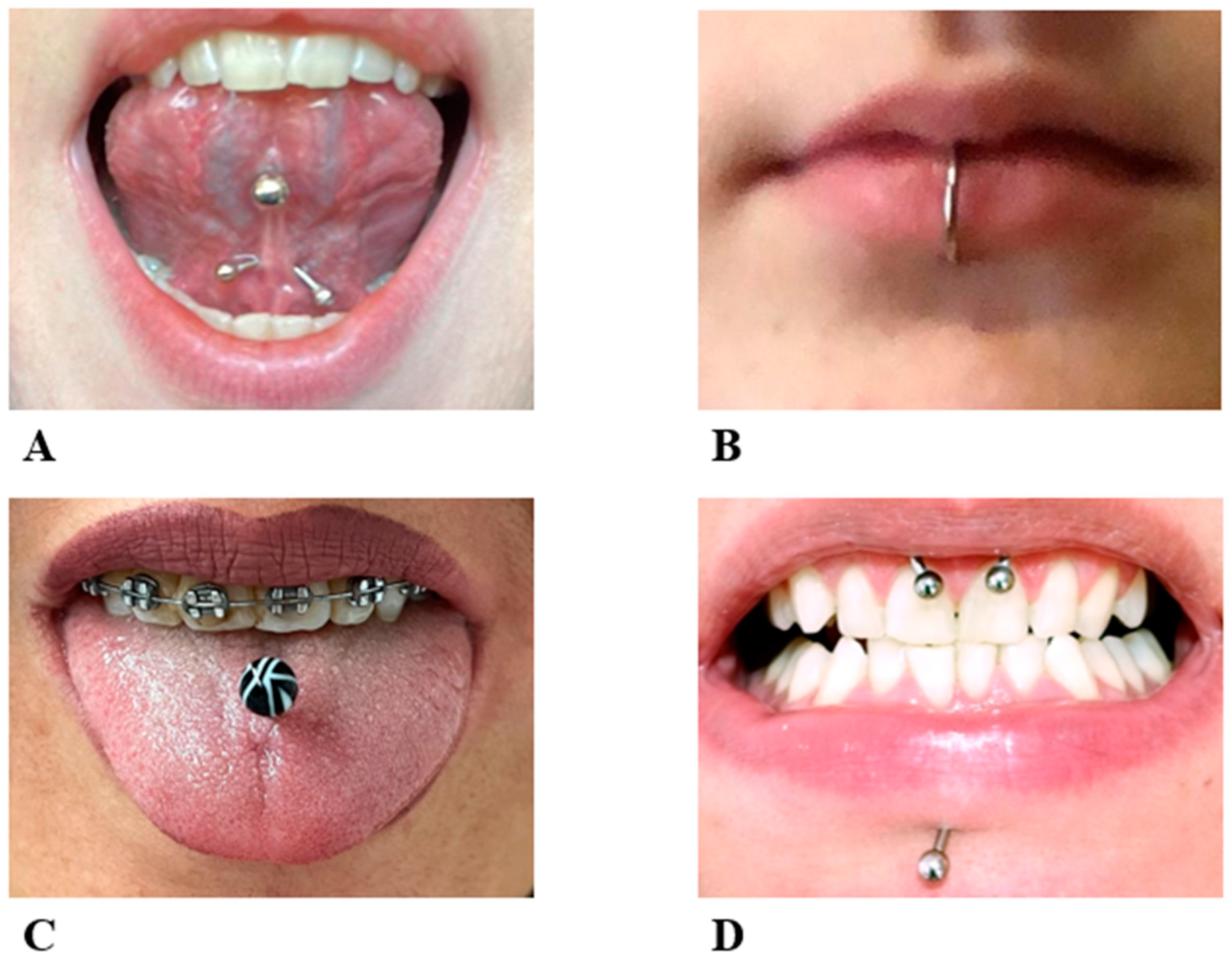 IJERPH | Free Full-Text | Oral Piercing: A Pretty Risk&mdash;A Scoping  Review of Local and Systemic Complications of This Current Widespread  Fashion