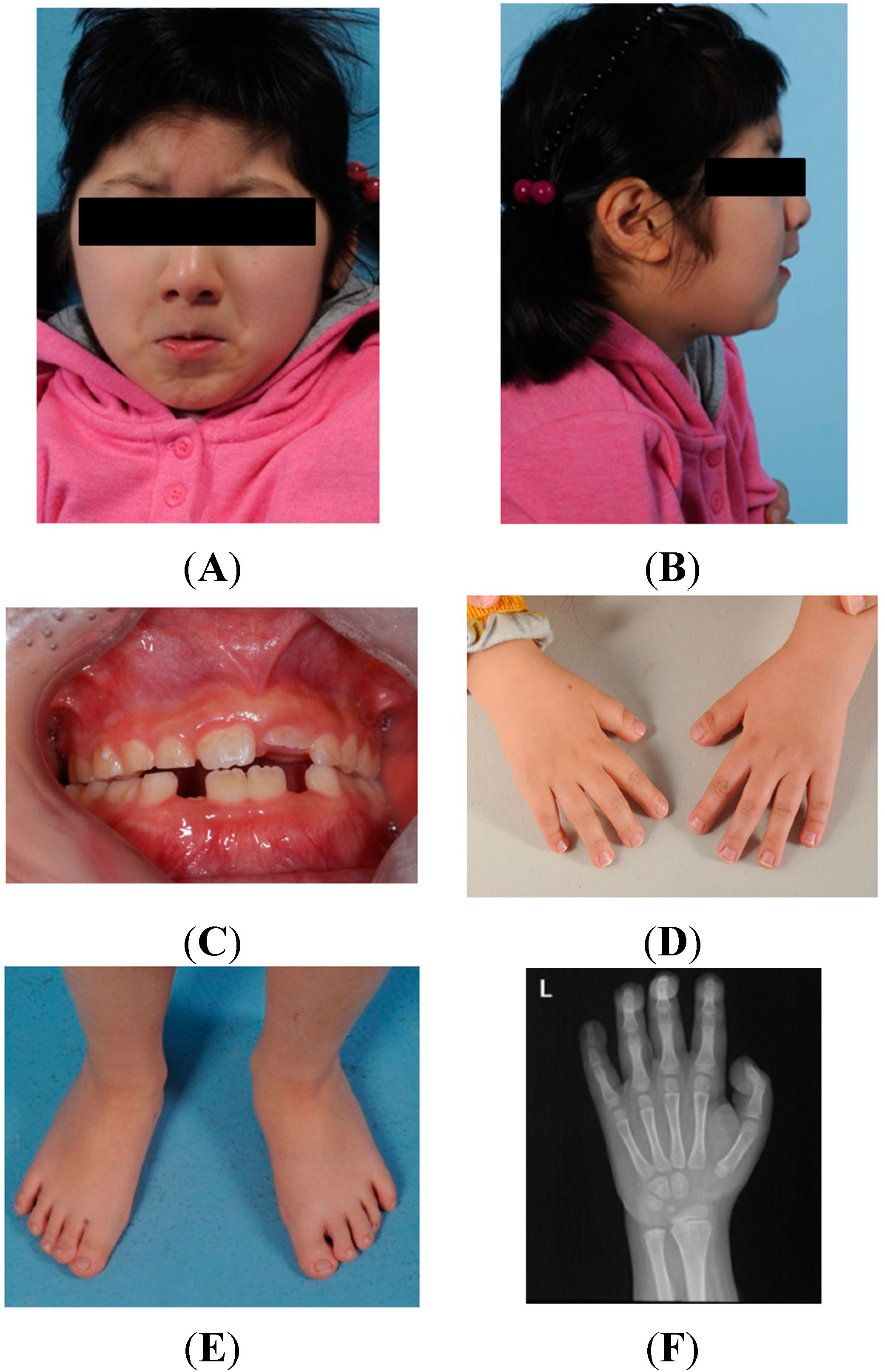A novel mutation c.4003 G>C in the CREBBP gene in an adult female with  Rubinstein–Taybi syndrome presenting with subtle dysmorphic features - Li -  2010 - American Journal of Medical Genetics Part