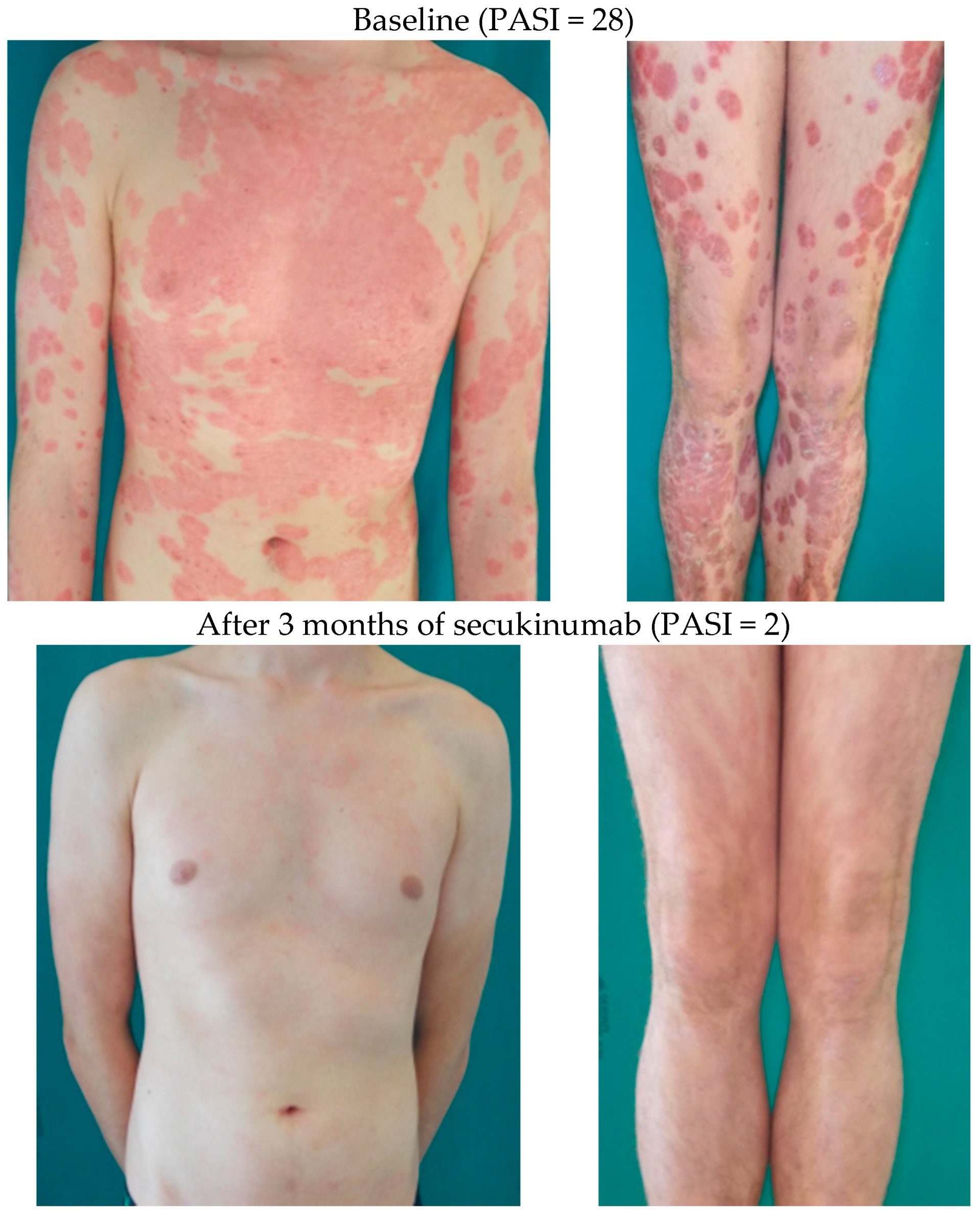 IJMS | Free Full-Text | Treatment Approaches to Moderate to Severe Psoriasis  | HTML