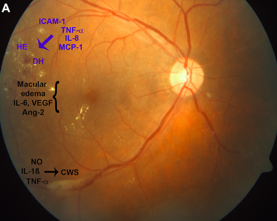 IJMS  Free FullText  Role of Inflammation in Diabetic Retinopathy
