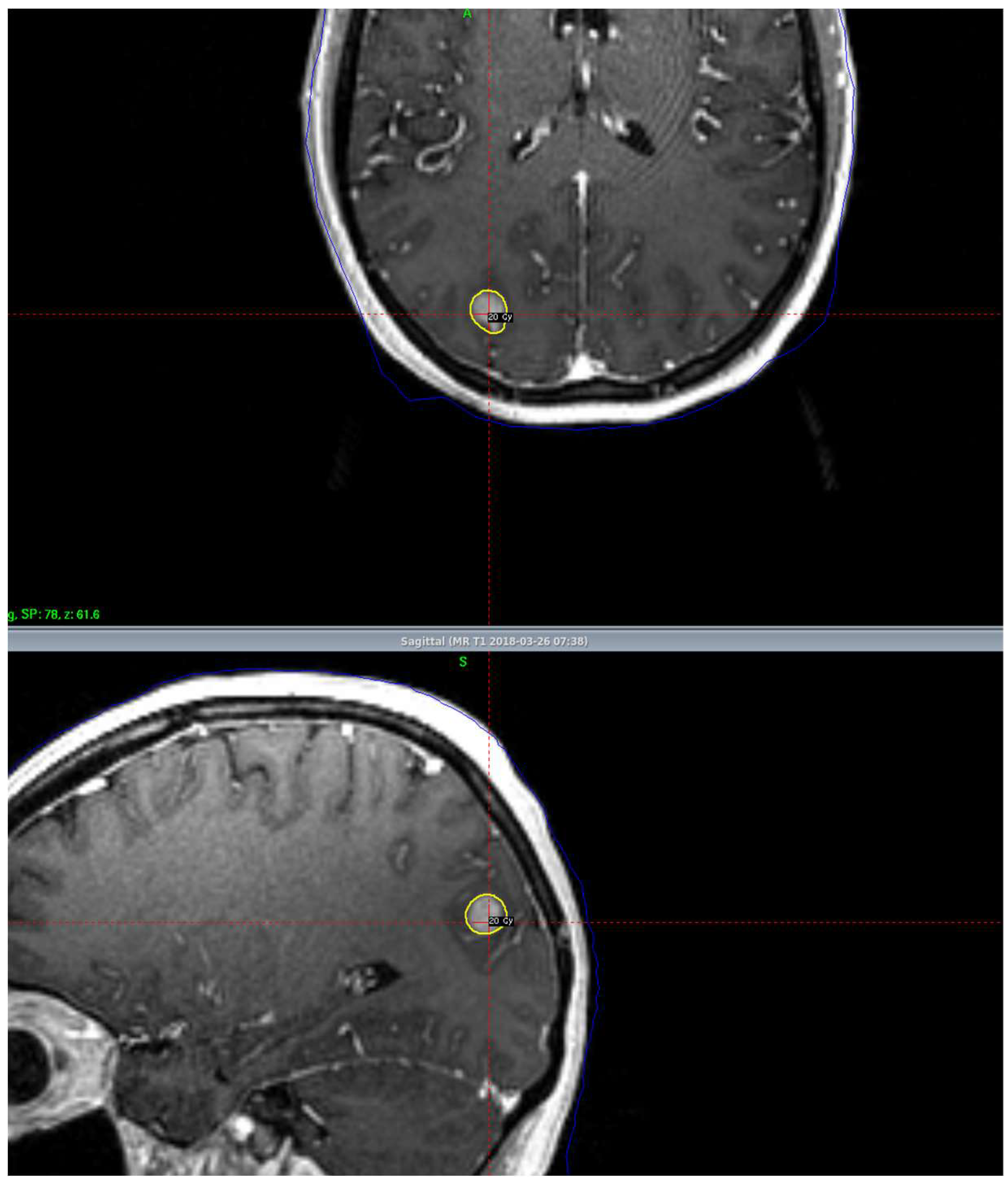 IJMS Free FullText Stereotactic Radiosurgery and