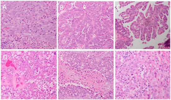 IJMS | Free Full-Text | High-Grade Serous Ovarian Cancer: Basic ...