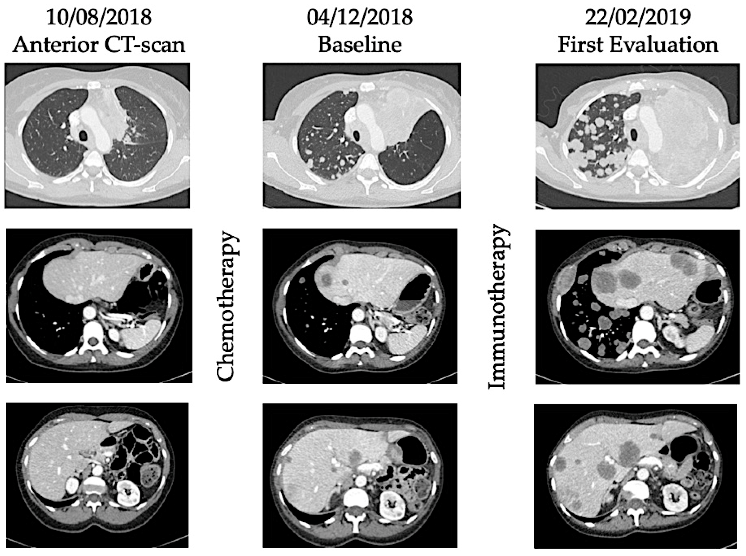 IJMS | Free Full-Text | Hyperprogression Under Immunotherapy