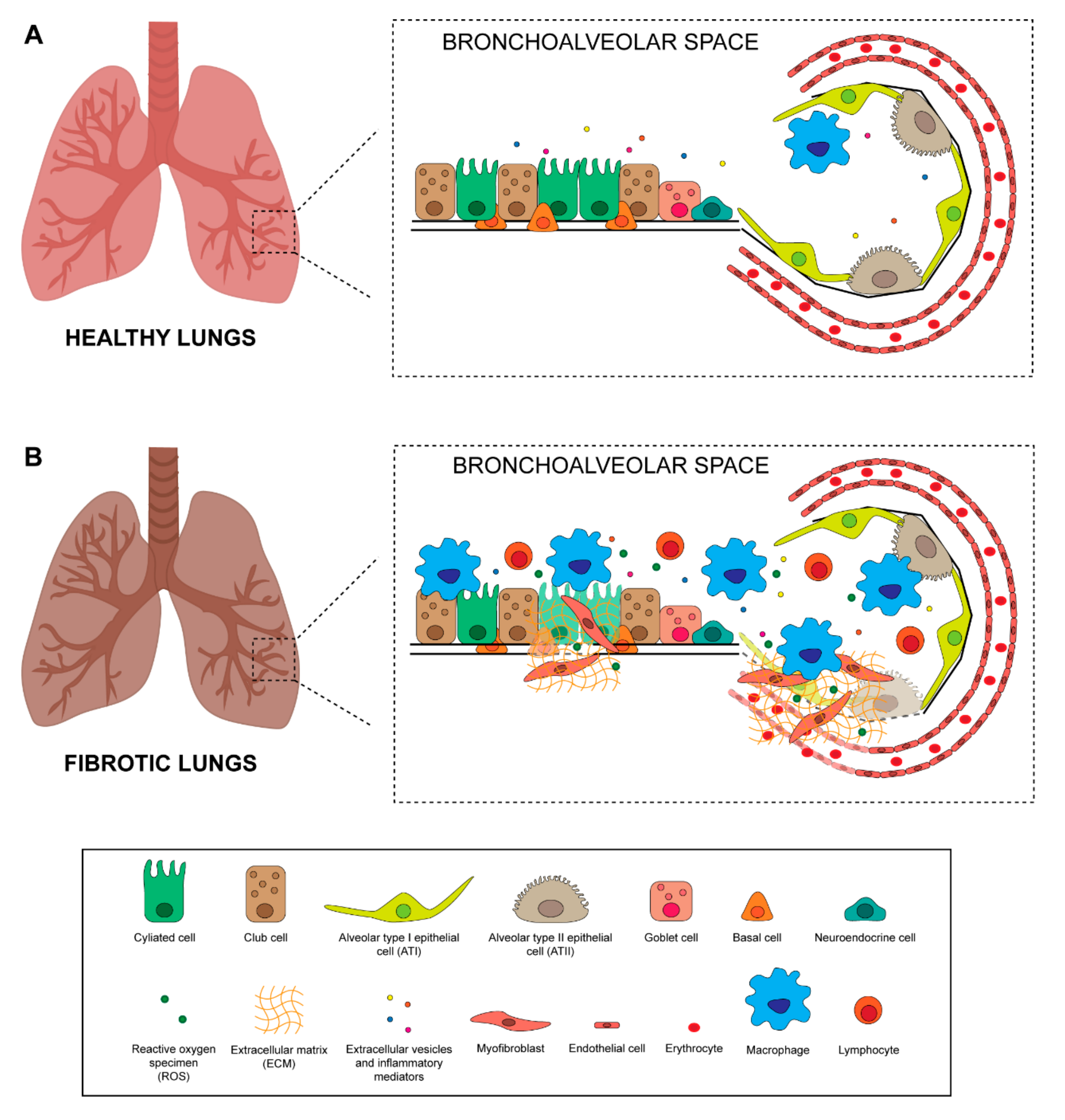 Radiation Fibrosis Lung