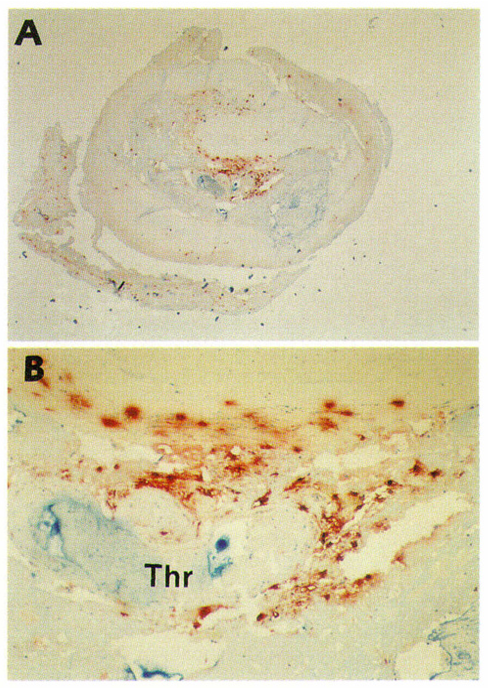 A Definition of Advanced Types of Atherosclerotic Lesions and a  Histological Classification of Atherosclerosis