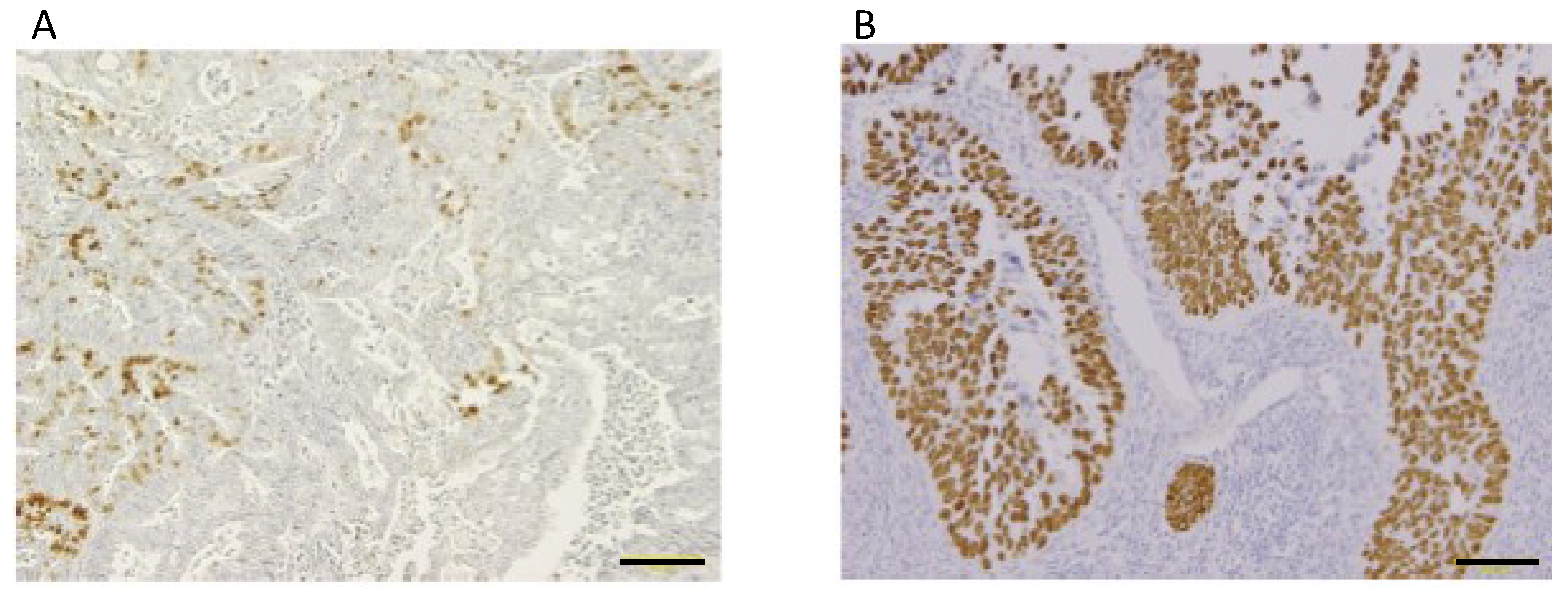 P53 negative serous carcinoma