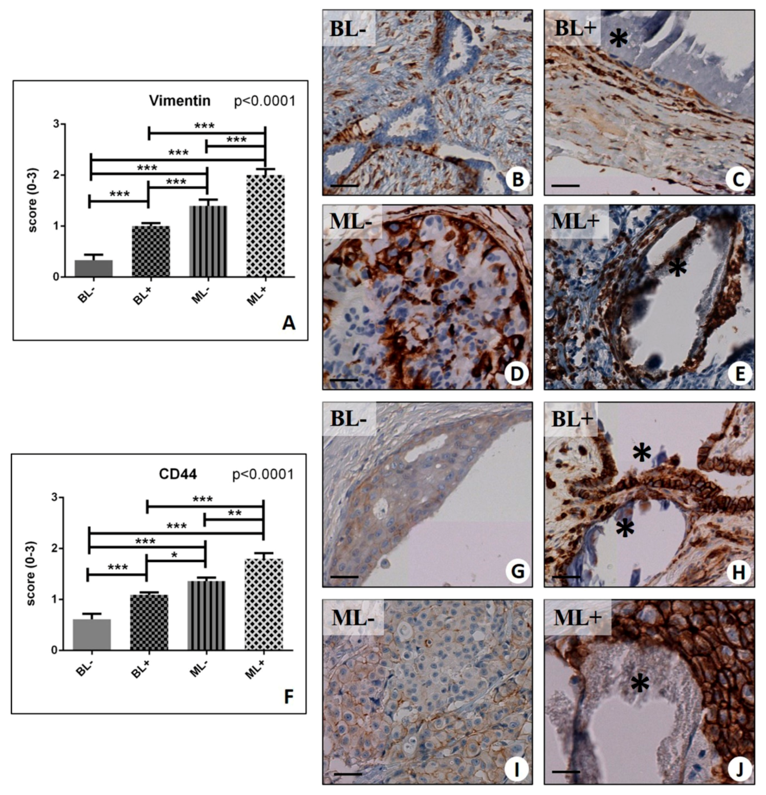 Ijms Free Full Text Microcalcifications Drive Breast Cancer Occurrence And Development By Macrophage Mediated Epithelial To Mesenchymal Transition Html