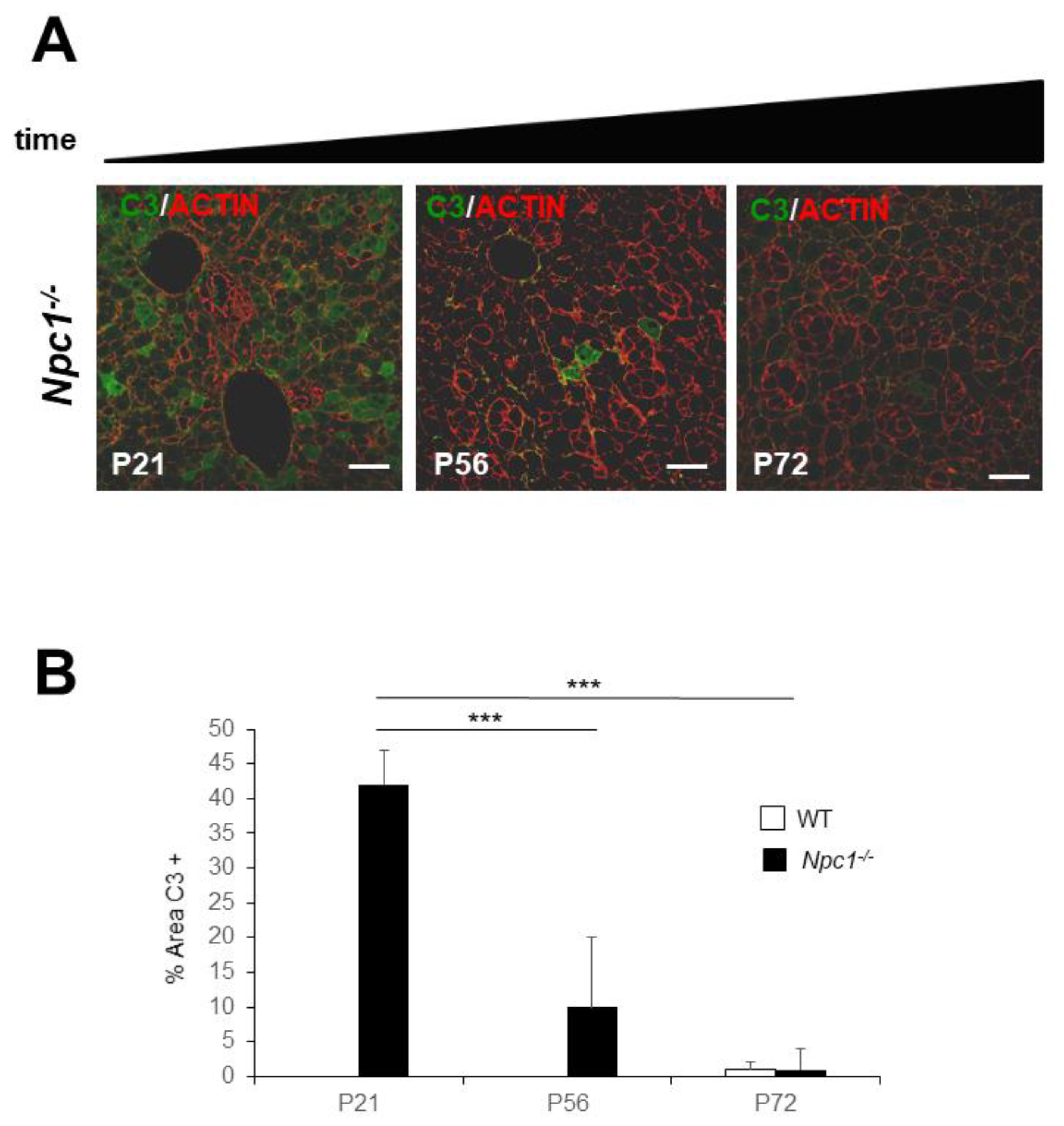 Hepatocellular carcinoma as a complication of Niemann‐Pick disease