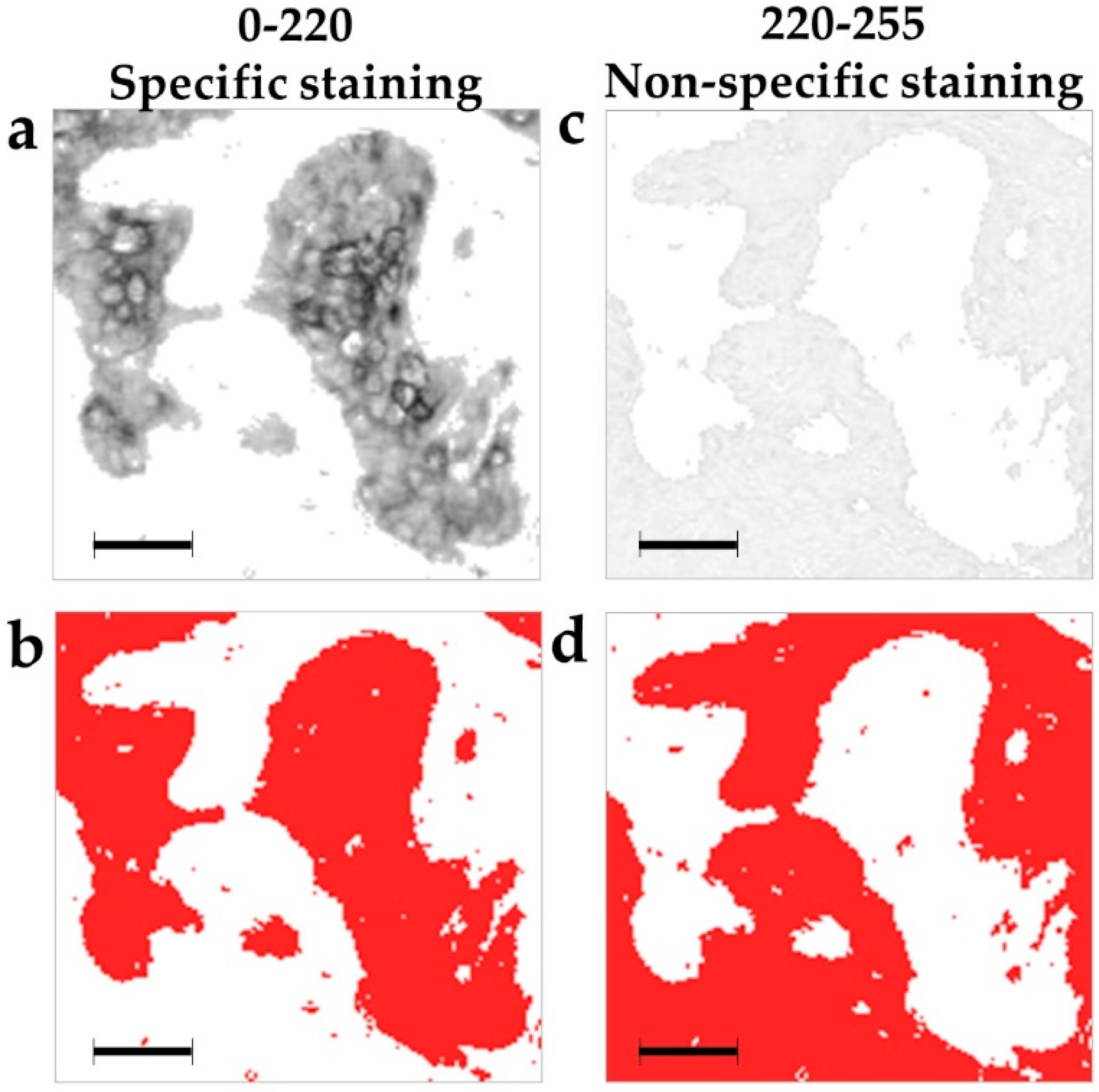 Analysis of Spatial Distribution and Prognostic Value of Different Pan ...