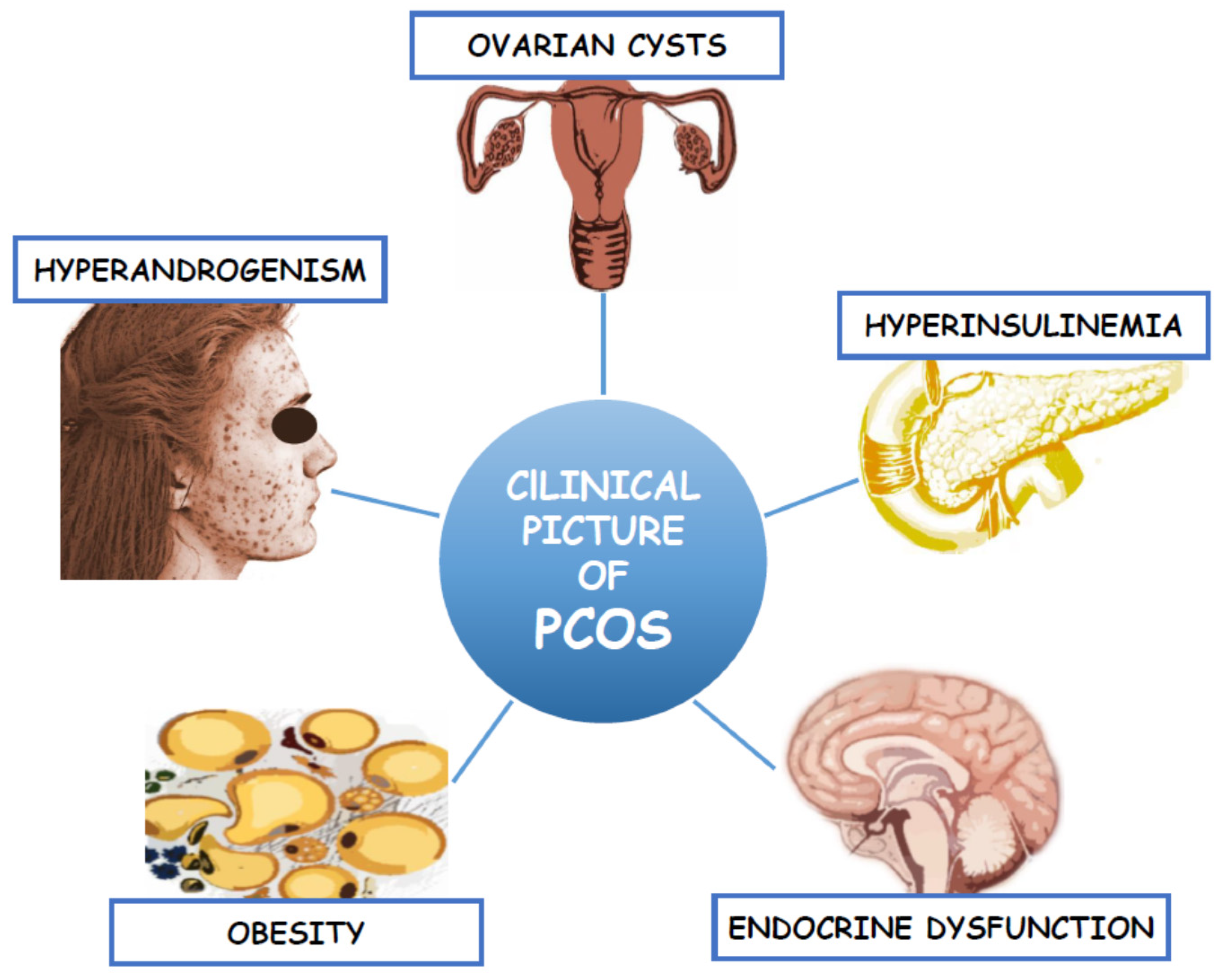 IJMS | Free Full-Text | Metabolomic Insight into Polycystic Ovary Syndrome—An  Overview