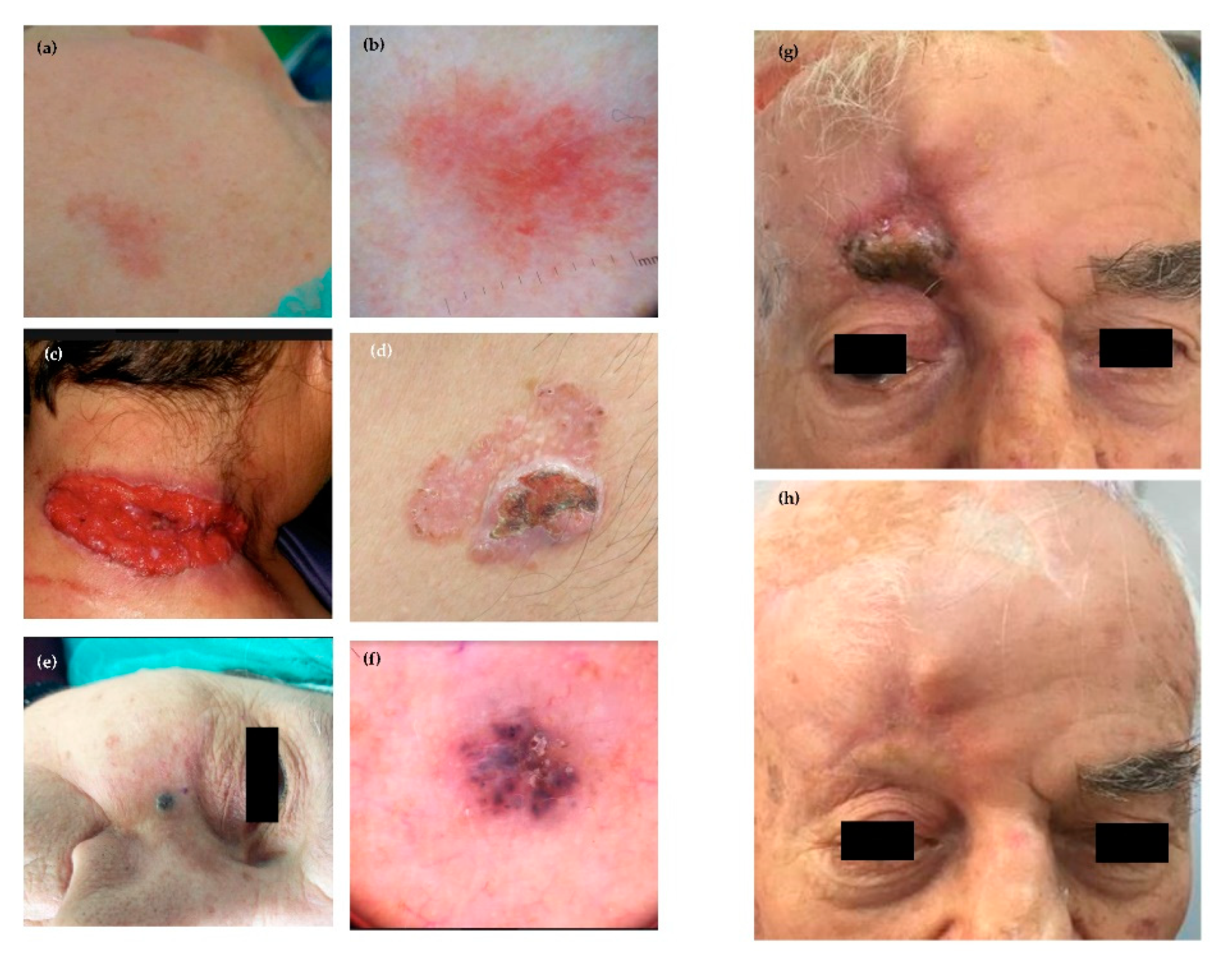 IJMS | Free Full-Text | Non-Melanoma Skin Cancers: Biological and Clinical  Features | HTML