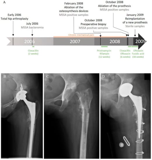 Ijms Free Full Text Investigation Of A Staphylococcus Argenteus Strain Involved In A Chronic Prosthetic Joint Infection Html