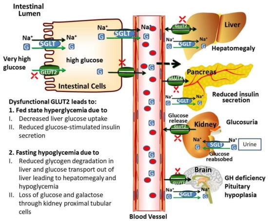 IJMS | Free Full-Text | Fanconi–Bickel Syndrome: A Review of the ...