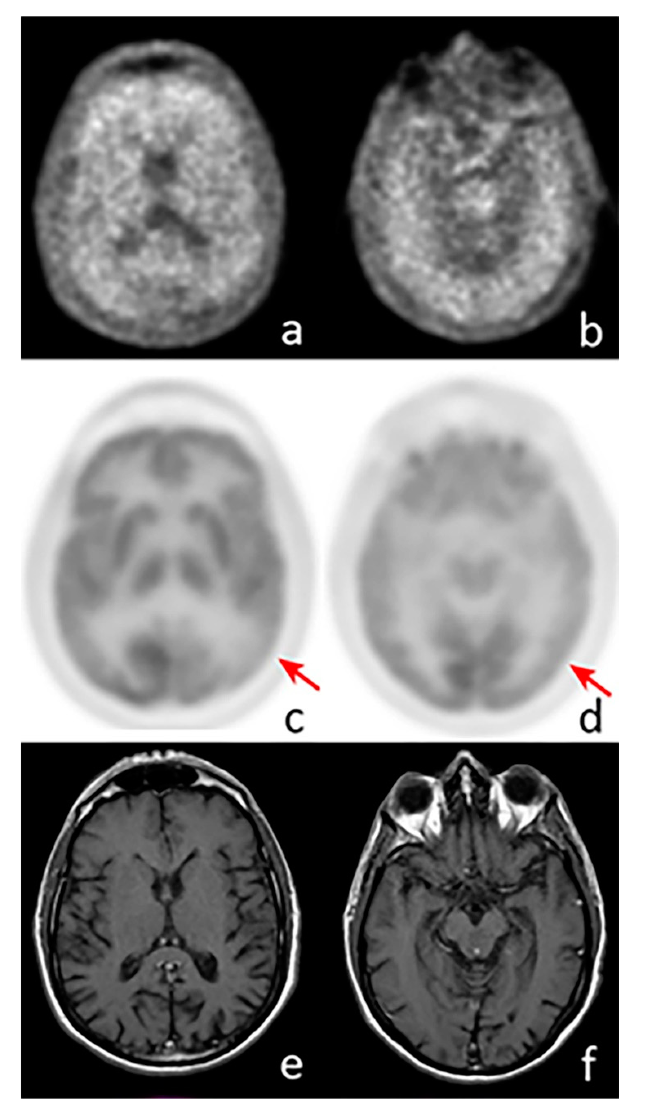IJMS | Free Full-Text | Positron Emission Tomography (PET) and Neuroimaging  in the Personalized Approach to Neurodegenerative Causes of Dementia