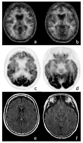 IJMS | Free Full-Text | Positron Emission Tomography (PET) and Neuroimaging  in the Personalized Approach to Neurodegenerative Causes of Dementia | HTML
