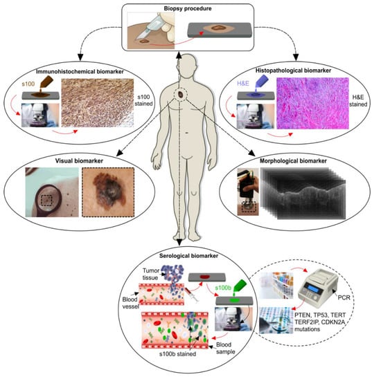 Ijms Free Full Text Melanoma Biomarkers And Their Potential