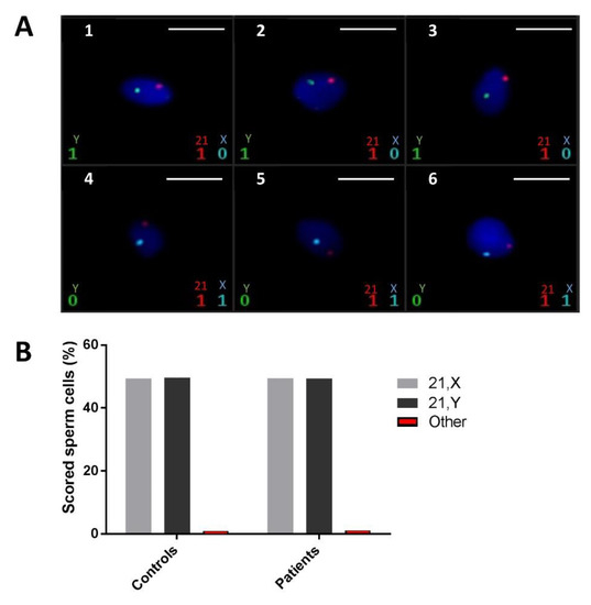 Ijms Free Full Text Identification And Characterization Of The Most Common Genetic Variant Responsible For Acephalic Spermatozoa Syndrome In Men Originating From North Africa Html