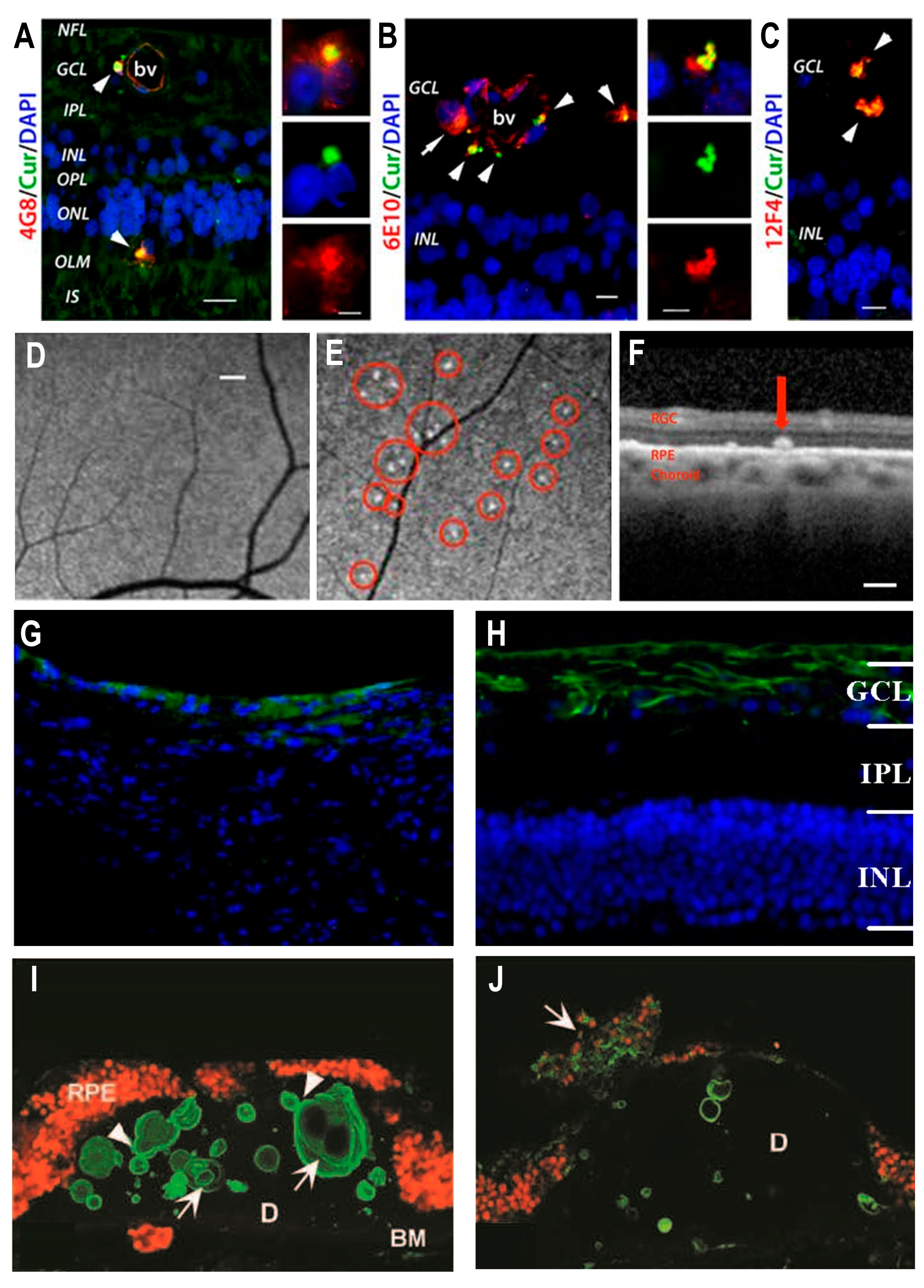 IJMS | Free Full-Text | Role of Retinal Amyloid-β in Neurodegenerative  Diseases: Overlapping Mechanisms and Emerging Clinical Applications