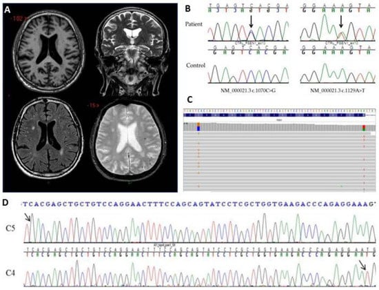 IJMS | Free Full-Text | PSEN1 Compound Heterozygous Mutations ...