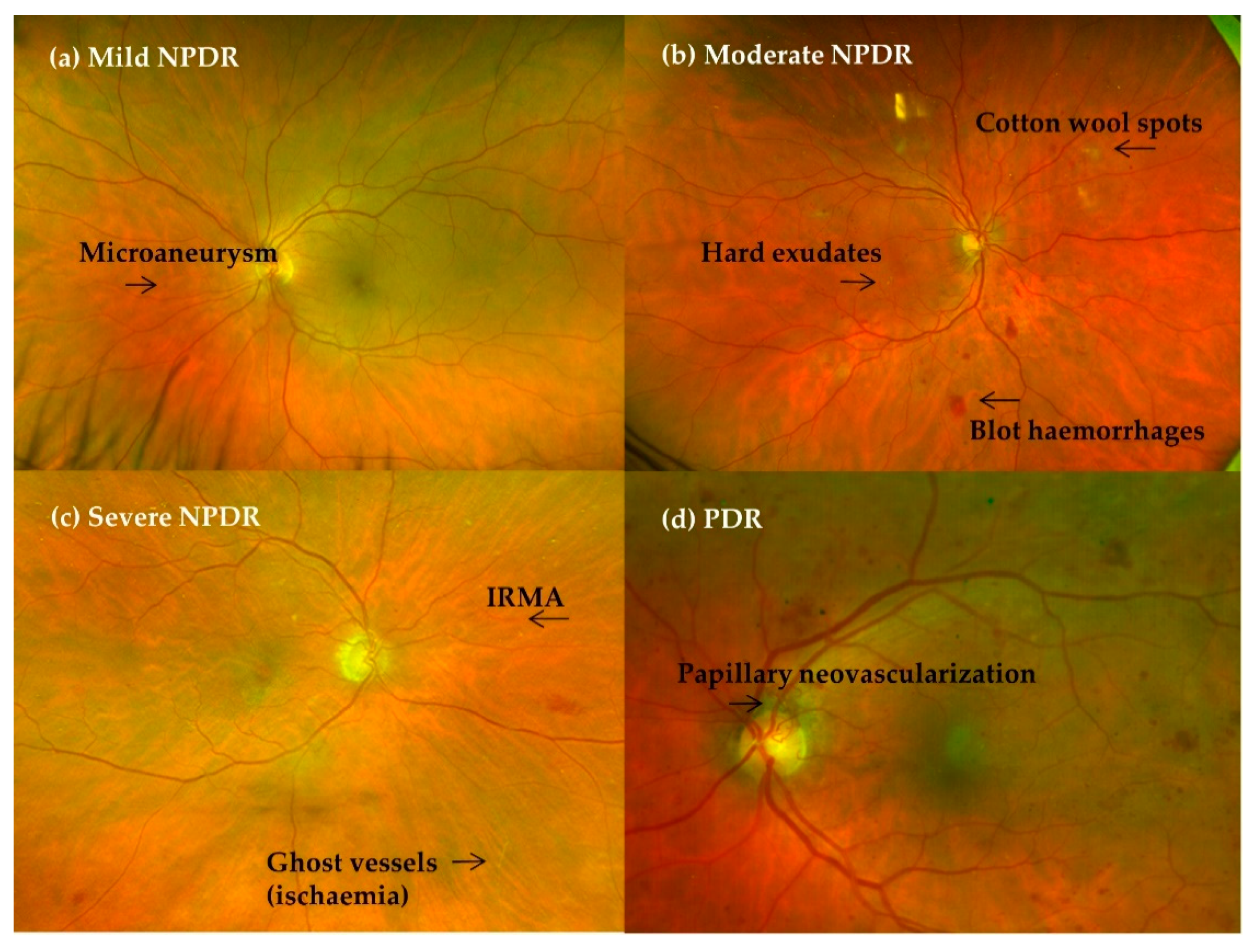IJMS | Free Full-Text | Role of Oral Antioxidant Supplementation in the  Current Management of Diabetic Retinopathy
