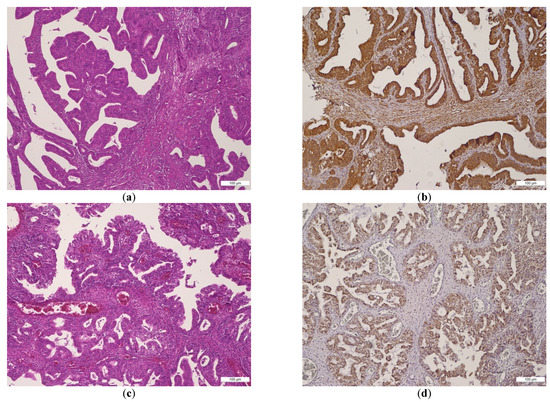 IJMS | Free Full-Text | BMI-1 Expression Heterogeneity in  Endometriosis-Related and Non-Endometriotic Ovarian Carcinoma | HTML