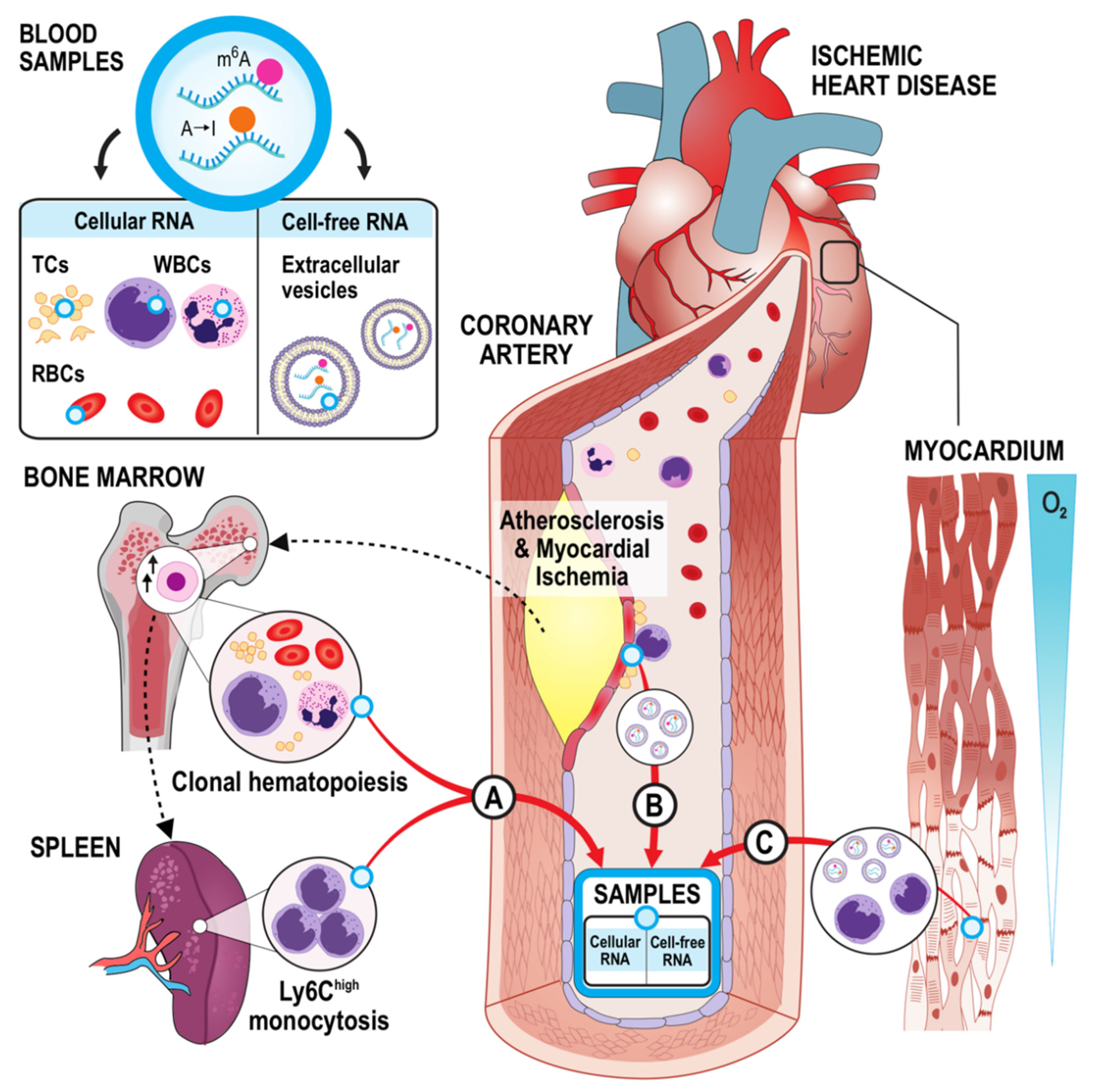 Ischemic Heart Disease