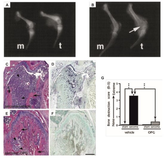 IJMS | Free Full-Text | Osteosarcoma and Metastasis Associated Bone  Degradation—A Tale of Osteoclast and Malignant Cell Cooperativity