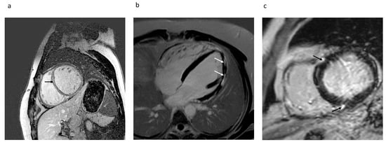 Echocardiography and cardiovascular magnetic resonance based evaluation of myocardial  strain and relationship with late gadolinium enhancement, Journal of  Cardiovascular Magnetic Resonance