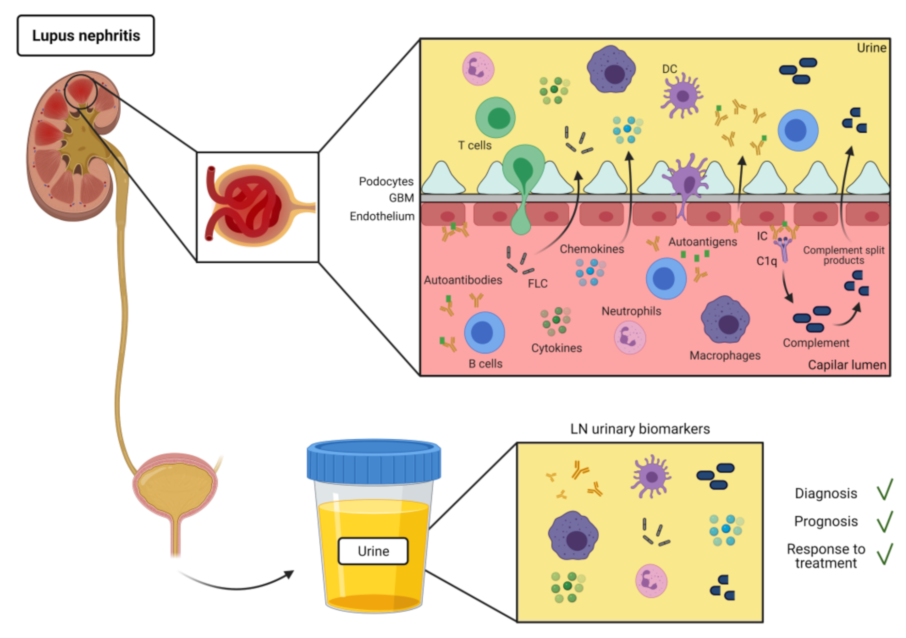 IJMS | Free Full-Text | Immune-Related Urine Biomarkers for the Diagnosis  of Lupus Nephritis