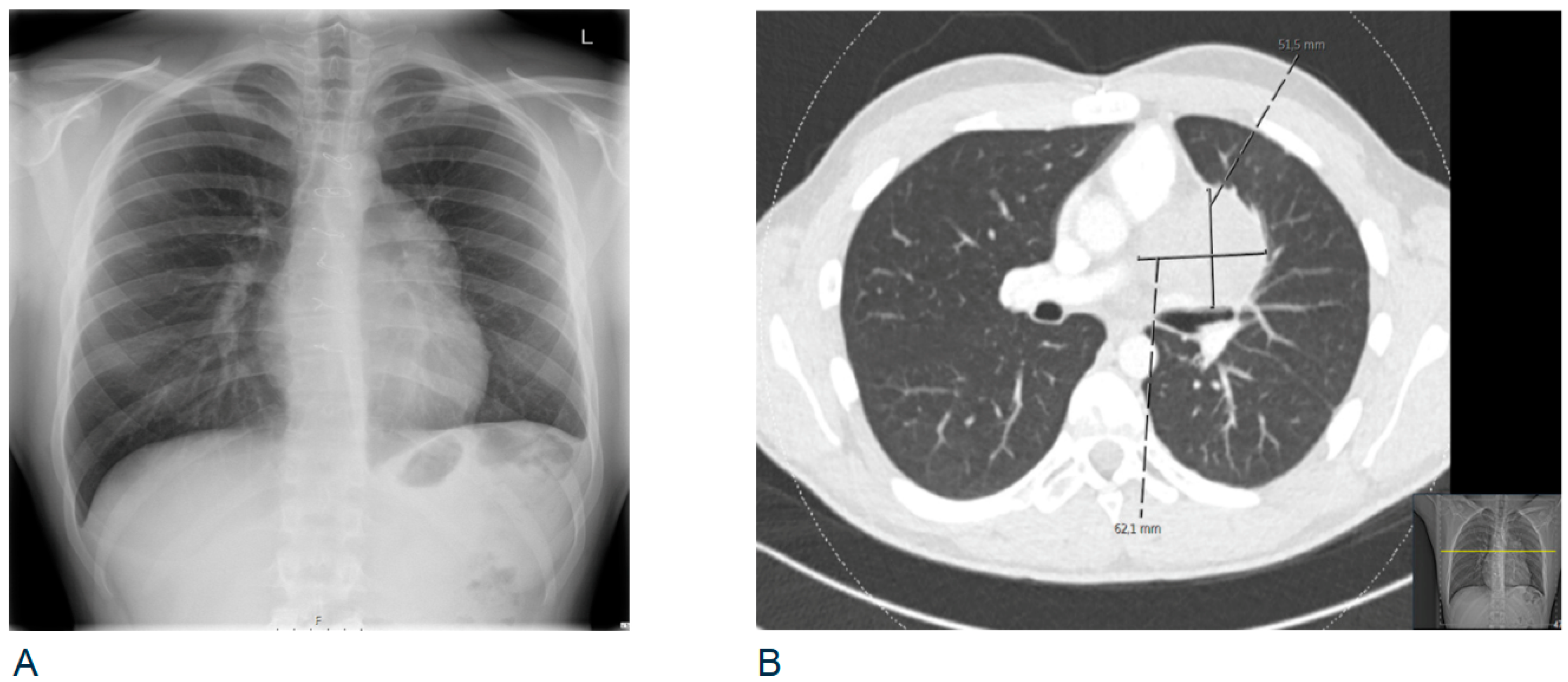 Mediastinal Germ Cell Tumor