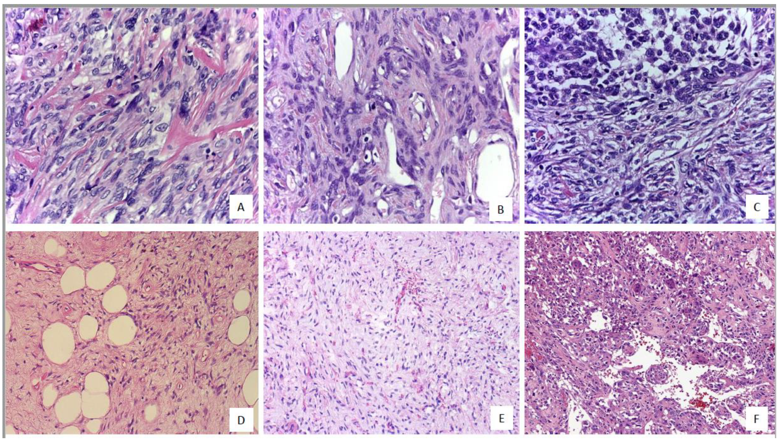 IJMS | Free Full-Text | Solitary Fibrous Tumor: Integration of