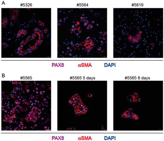 IJMS | Free Full-Text | Ovarian Cancer Cells in Ascites Form Aggregates ...