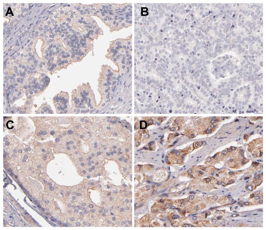 IJMS | Free Full-Text | P-Glycoprotein and Androgen Receptor Expression ...